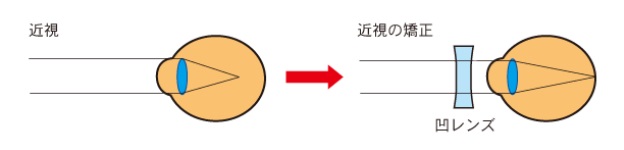 近視矯正のにレンズを使用した場合